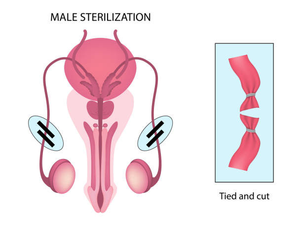 Understanding Vasectomy: A Permanent, Safe, and Effective Family Planning Option for Men